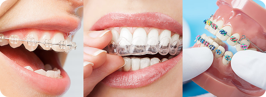 What Dental Issues Do Braces Correct and Prevent? - Lineberger Orthodontics